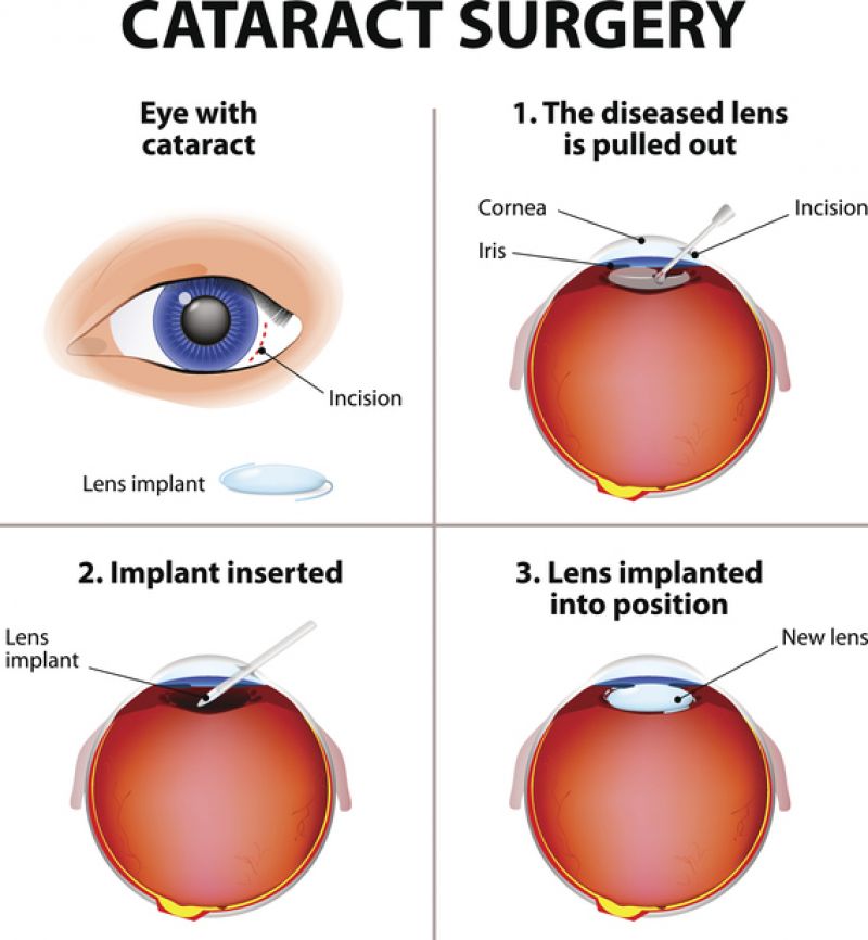 A diagram of a cataract operation.